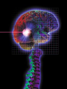 Laser Cancer Detection