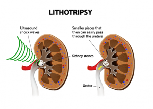 lithotripsy