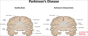 parkinson disease